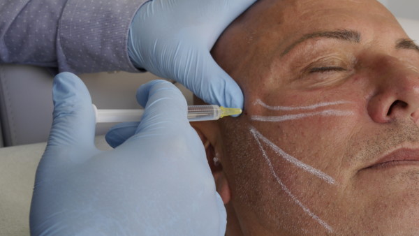 Retaining Ligaments Facelift + Perorale Lippen Contouring – Bild 3